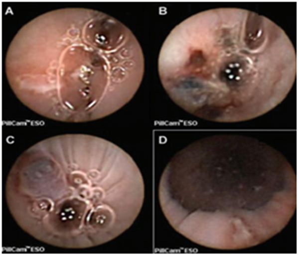 「房颤专项能力培训第3期」许静：心房食管瘘的预防、早期发现及处理