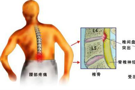 腰突出压迫神经腿痛如何康复锻炼,腰突压迫腿麻康复锻炼操