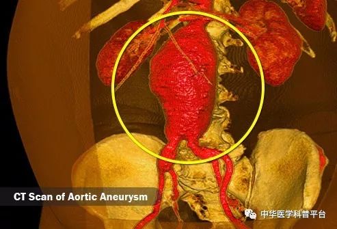 高血压停药的危害,高血压带来的危害有哪些