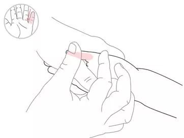 小儿推拿新生儿的舌苔,小儿舌苔薄呈地图状