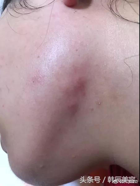 防止脸上长粉刺的方法,脸上长斑要当心