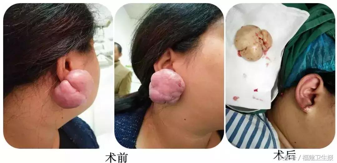 打耳洞导致长了小肉球,打耳洞耳朵长了个肉瘤
