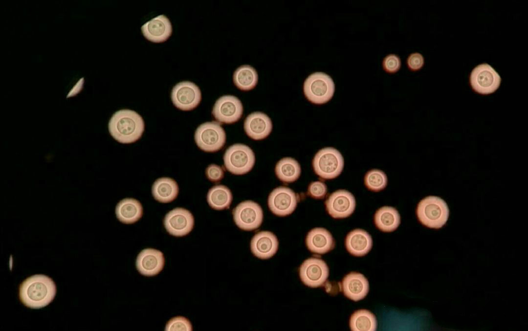 hiv感染者有症状的比例,身上多处真菌感染和hiv有关系吗