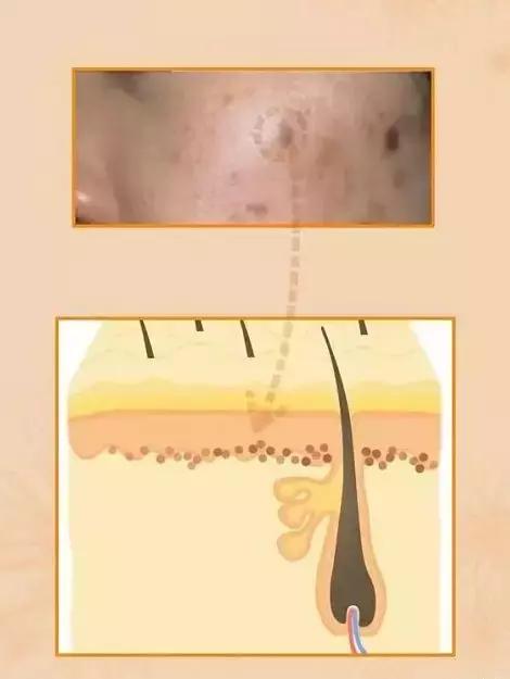 和痘印拜拜30天,跟青春痘说拜拜