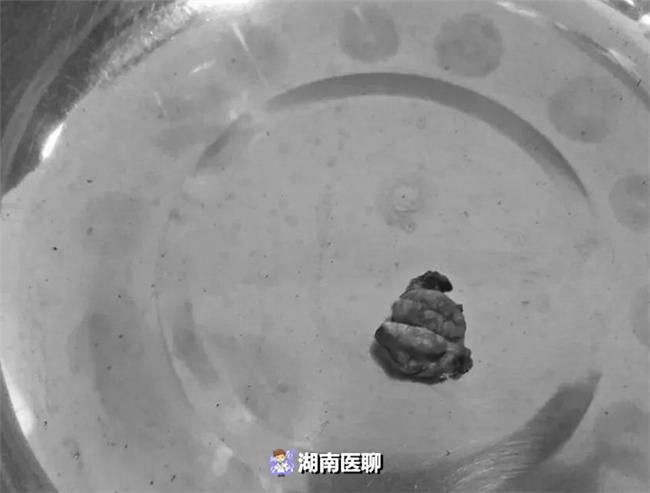 肾上腺肿瘤高血压,肾上腺肿瘤导致高血压怎么处理