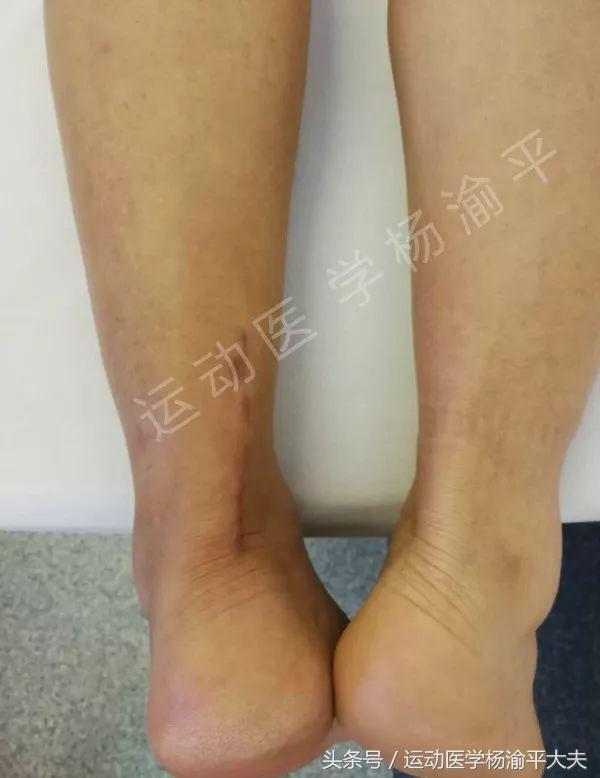 跟腱手术伤口为什么不好愈合,跟腱手术需要消肿才能手术吗