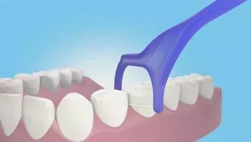 原来蛀牙是这样修复,牙齿开始蛀牙怎样防止恶化