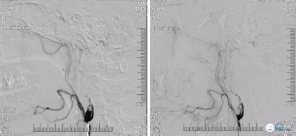 颈动脉闭塞介入治疗的风险,慢性动脉闭塞症病例