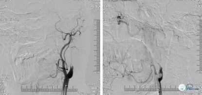 颈动脉闭塞介入治疗的风险,慢性动脉闭塞症病例