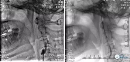 颈动脉闭塞介入治疗的风险,慢性动脉闭塞症病例