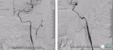 颈动脉闭塞介入治疗的风险,慢性动脉闭塞症病例