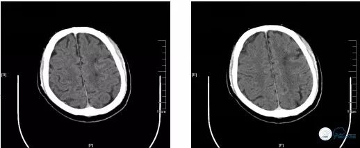 颈动脉闭塞介入治疗的风险,慢性动脉闭塞症病例