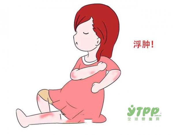 妊娠期糖尿病水肿,妊娠期水肿的处理方法