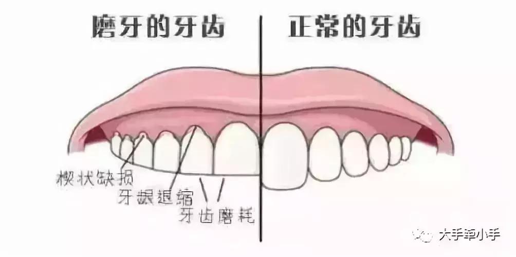 牙齿不齐矫正好还是做牙冠好,牙齿不齐矫正1个月的变化
