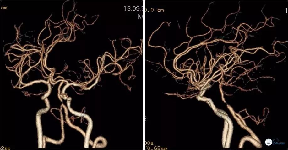 天坛周记｜左椎动脉开口及基底动脉串联狭窄血管内介入治疗1例