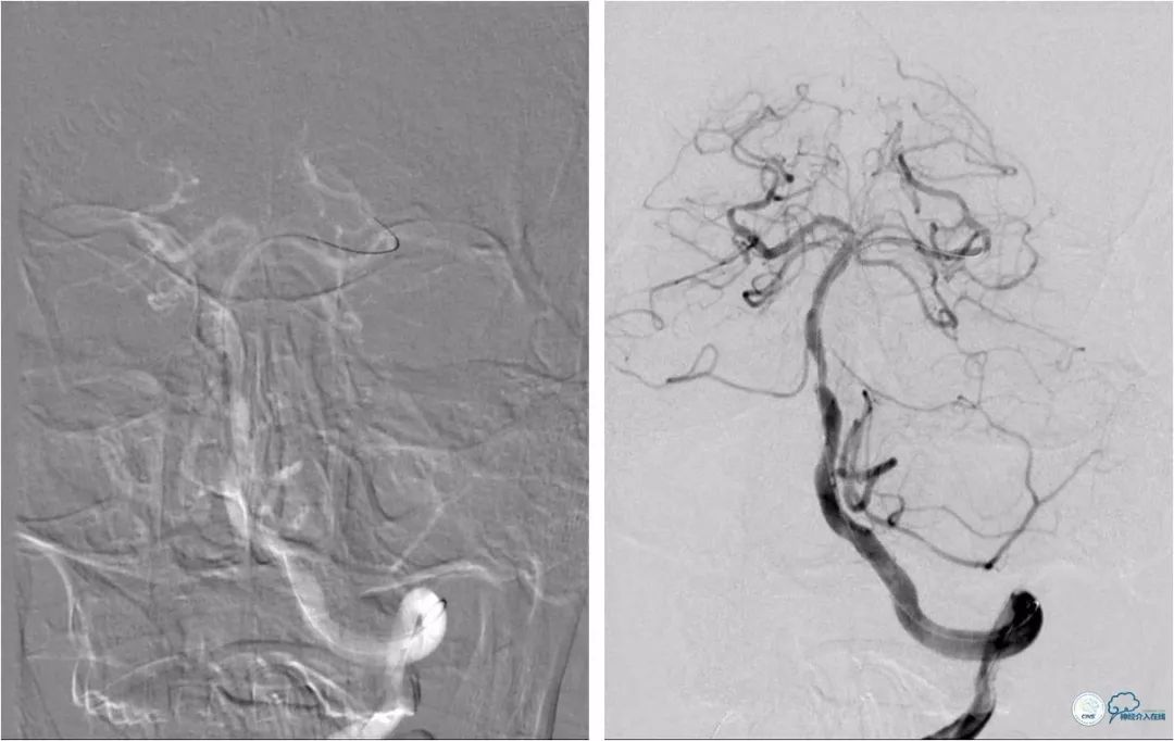 天坛周记｜左椎动脉开口及基底动脉串联狭窄血管内介入治疗1例