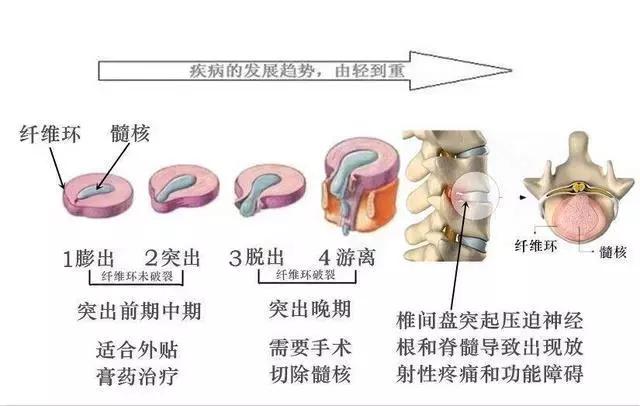 腰椎间盘突出复位锻炼,腰椎间盘突出坐骨神经痛康复锻炼
