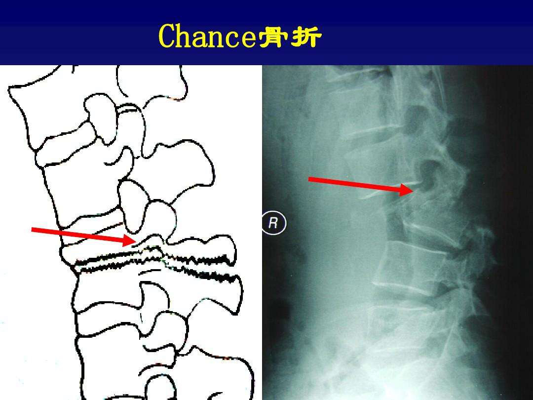 骨科肋骨骨折,中医骨科骨折