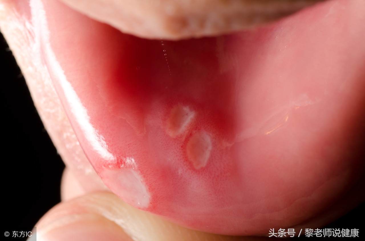 长期口腔溃疡中医如何根治好,长期口腔溃疡如何治疗及保健