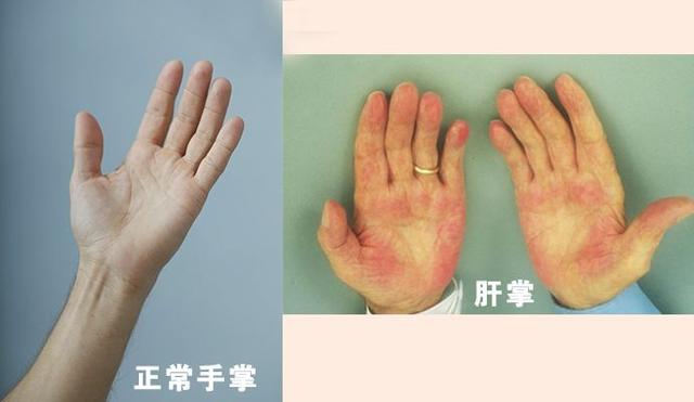 共抗乙肝共建绿色家园