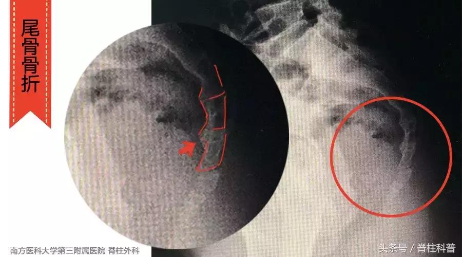 腰痛看了脊柱外科也没用,腰痛看骨科还是脊柱科