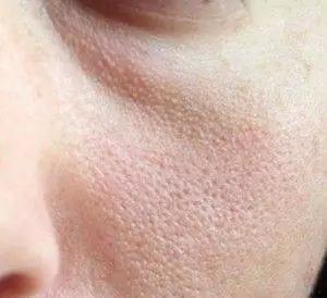 治疗毛孔粗大的护肤品,烟酰胺可以治疗毛孔粗大吗