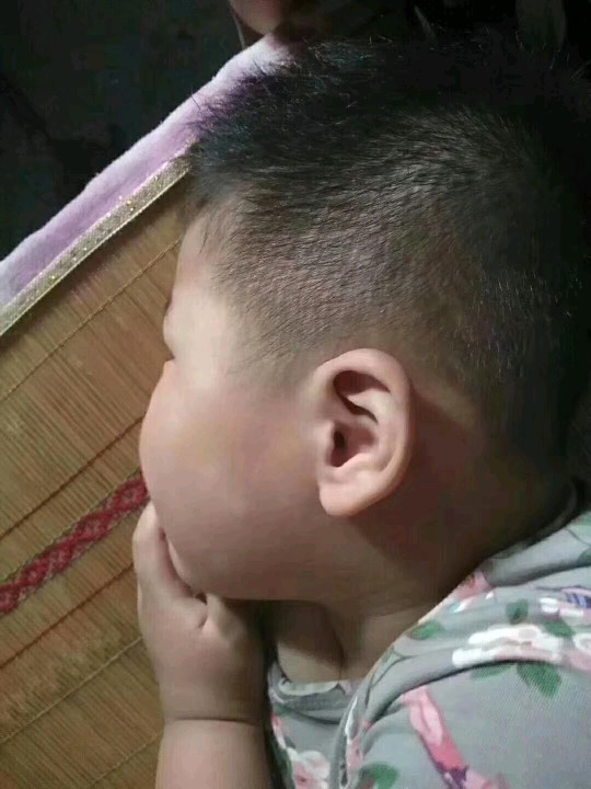 宝宝积食会导致全身皮肤黄吗,宝宝积食会导致脸上长小疙瘩吗