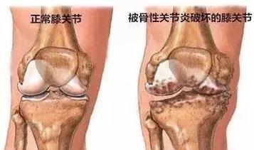 你还在“谈骨色变”吗？骨刺没你想的那么可怕