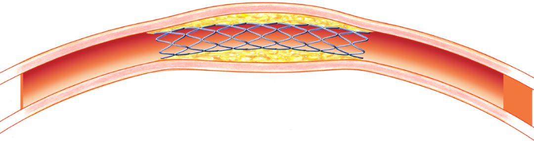 糖尿病下肢介入手术后注意事项,糖尿病下肢发凉怎么治疗