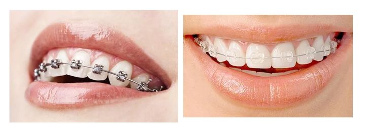 暑期孩子想矫正牙齿？北京口腔医院专家来解答这10个问题