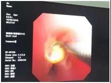 反复喘息呼吸急促,反复或持续性喘息