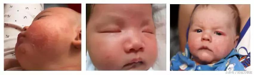 宝宝脸上湿疹反反复复怎么根除,一到春夏季宝宝身上长湿疹