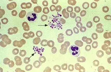 皮肤紫色瘀斑怎么快速恢复,瘀点瘀斑是哪个疾病的特点