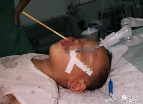 1岁男童吃烤肠摔倒3竹签刺入颅脑,一岁半男孩吃烤肠竹签刺入大脑