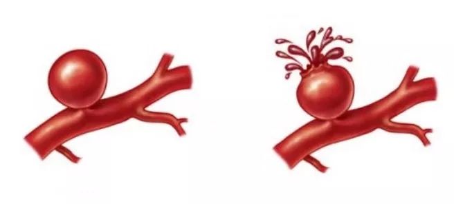 高血压怎么样才能发生猝死,高血压隐形杀手