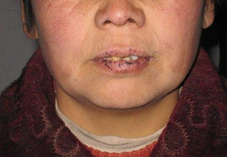 嘴唇黑痣有息肉,嘴巴上长痣了是肠道有息肉吗