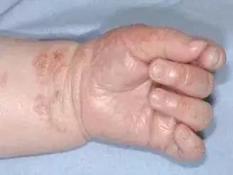 宝宝长小疹子后溃烂,宝宝的红疹子溃烂了