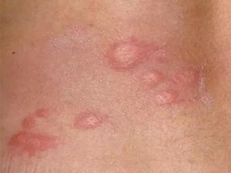 宝宝身上一大片的包是怎么回事,宝宝身上好多片包