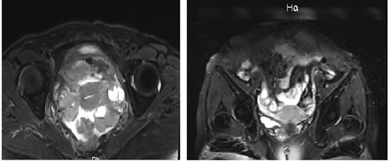 郑州市第一人民医院肿瘤外科：双通路热灌注化疗治疗卵巢癌显奇效