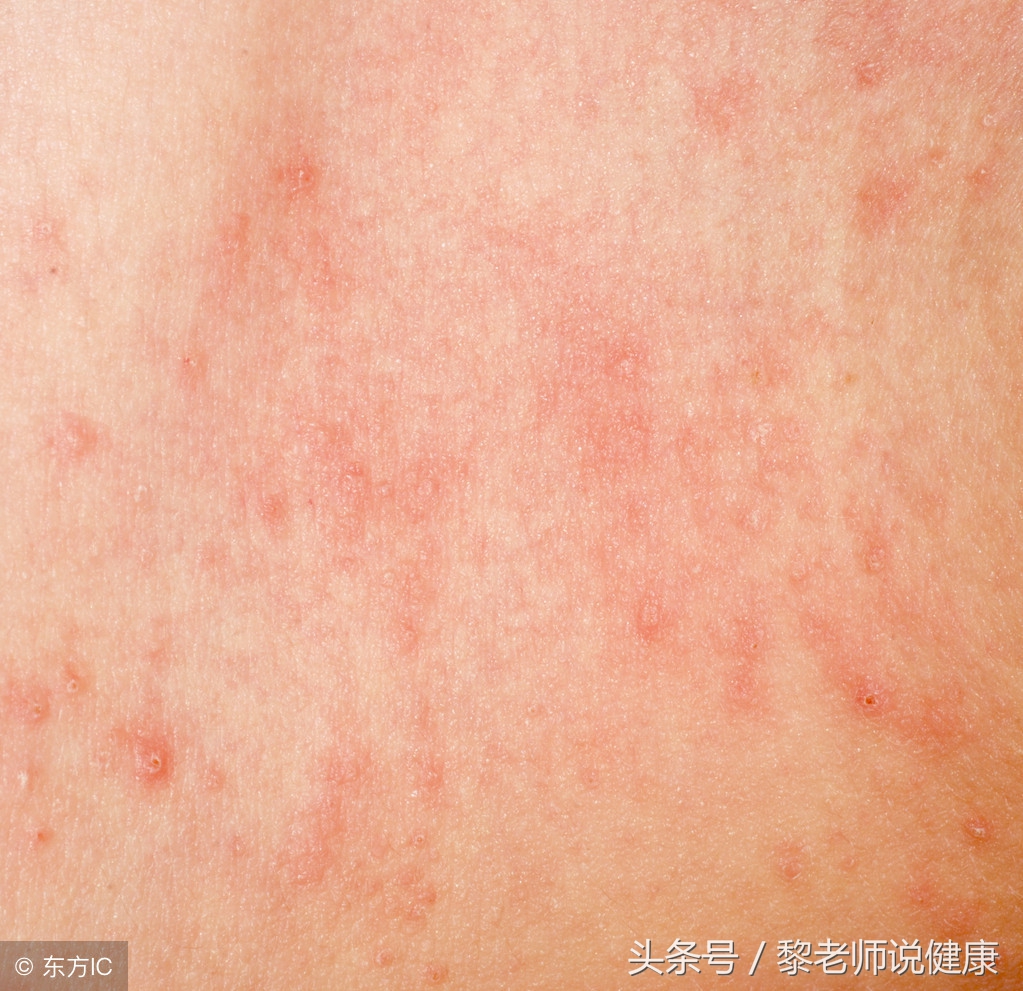 湿疹引起皮肤瘙痒吃什么药,湿疹导致心里痒怎么办