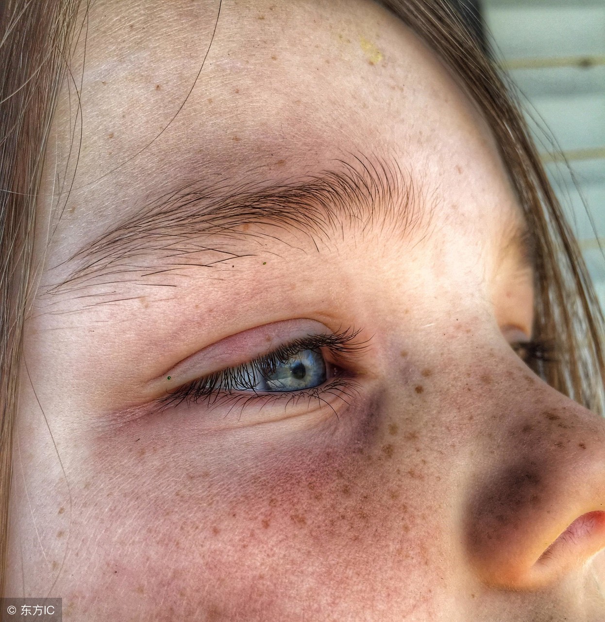 男士雀斑的治疗方法,雀斑样痣最新治疗方法