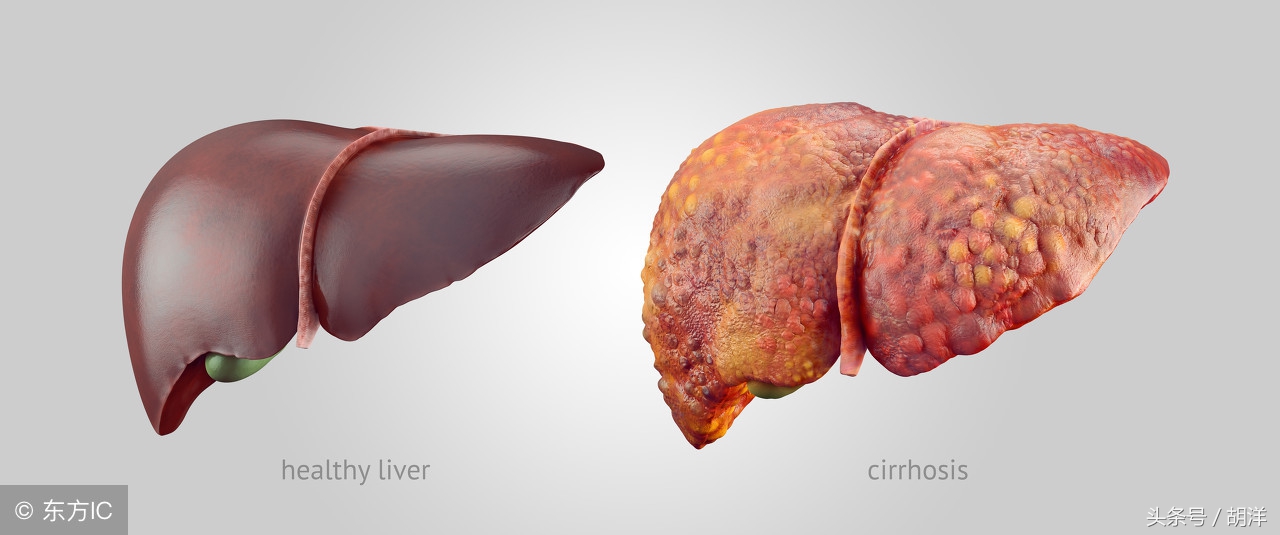 肺积水是怎么回事啊,肺积水由心脏原因造成的怎么办
