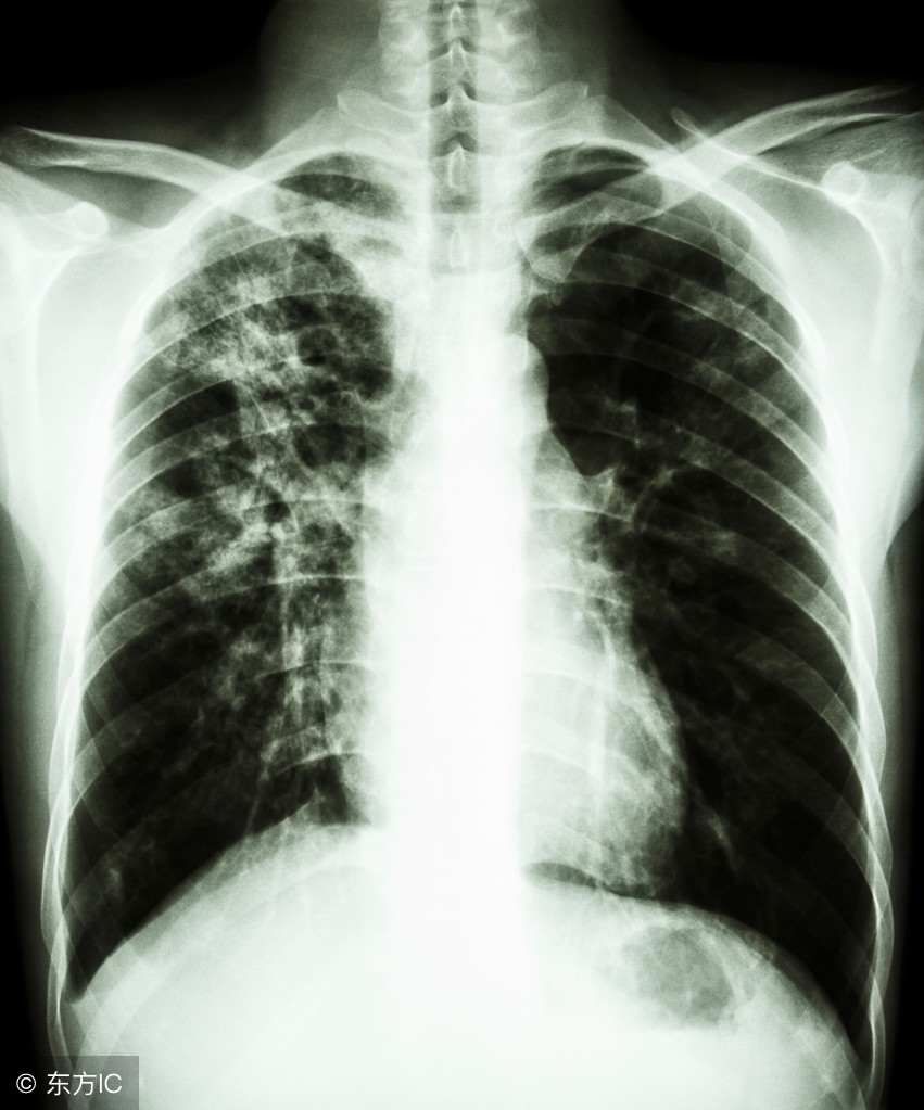 晚上盗汗咳嗽一定是肺结核吗,夜里盗汗咳嗽是肺结核吗