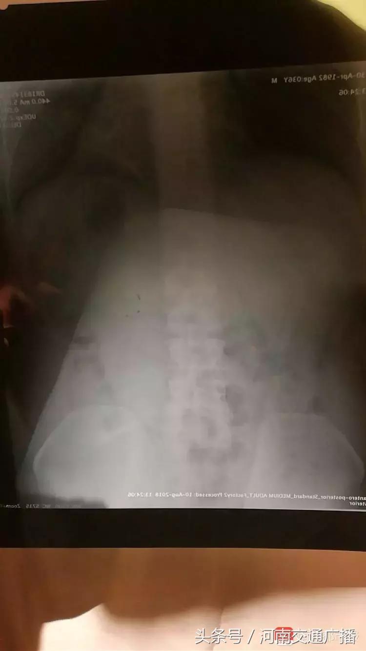 咔嚓!飞机餐吃出瓷器片,口腔被划破流血!更扎心的是赔偿……