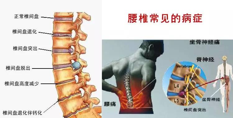 10分钟治腰背痛,一条毛巾治好腰背疼