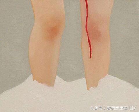 孕期阴道出血什么症状,孕期阴道出血症状