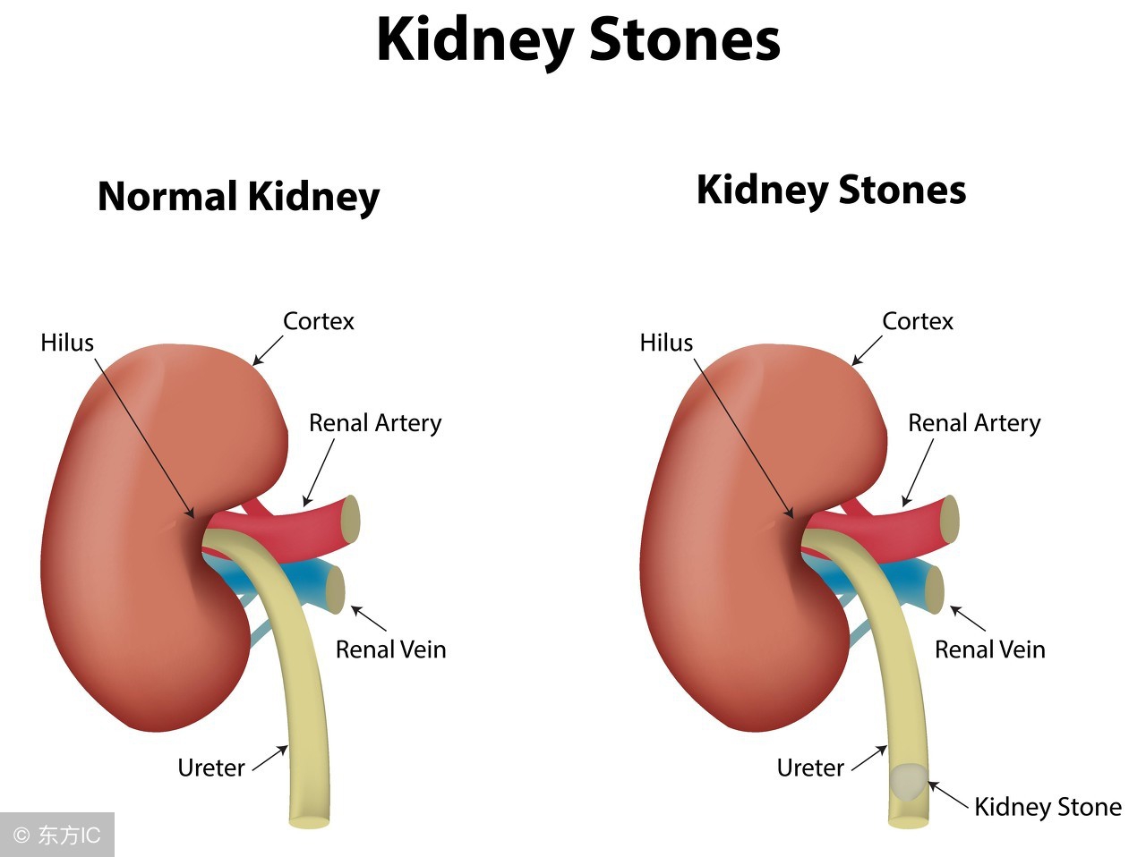 肾结石手术方法和注意事项,肾结石的手术方法最好的十种