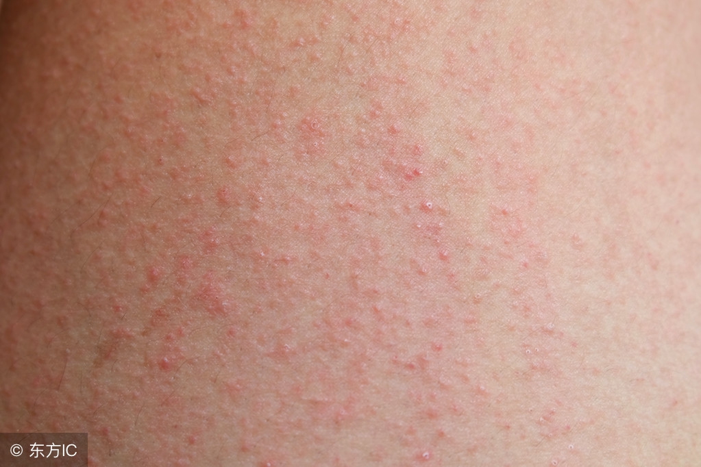 皮疹与湿疹区别在哪里？皮疹的饮食禁忌