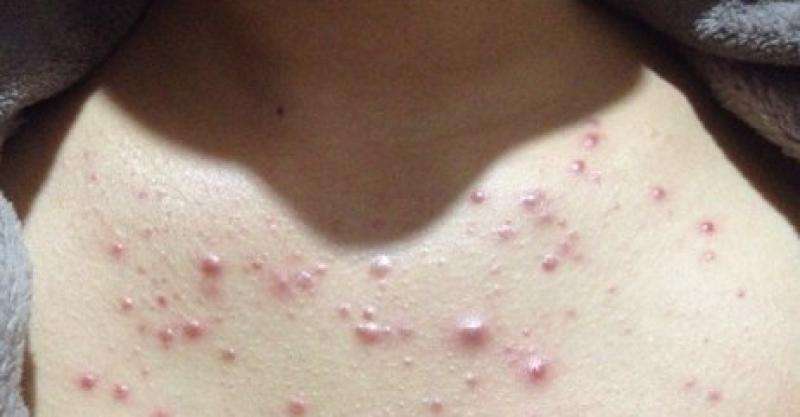 痣发红寓意,痣发红发痒怎么回事