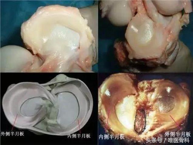 nba半月板损伤都是怎么恢复的,nba球星半月板损伤恢复比较好的